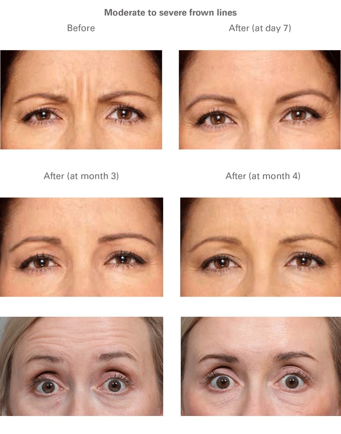 Collage of 6 before and after photos with 3 different people, focusing on botox results for the eye region