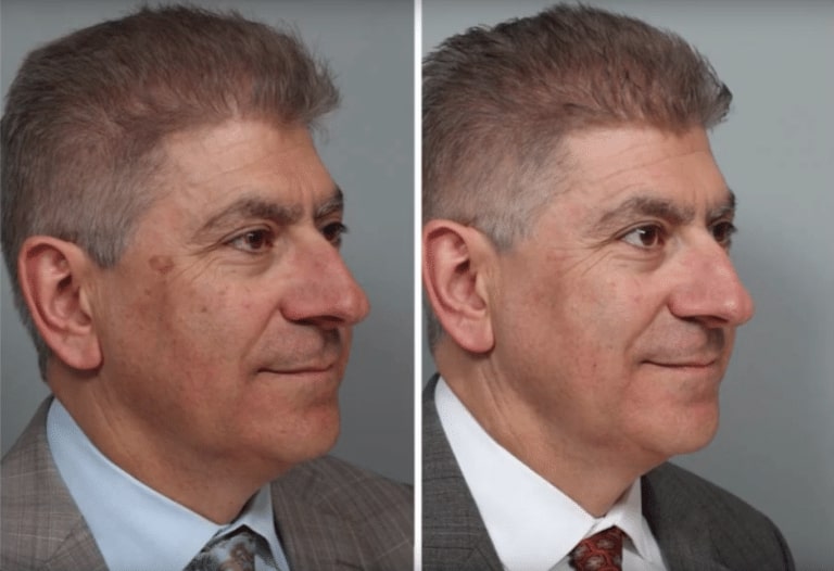 man before and after laser skin treatment, skin more clear after procedure