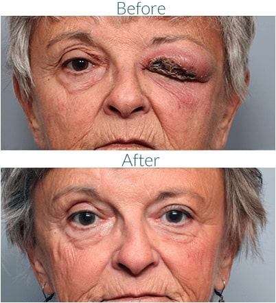 Orbital Infection Treatment Denver CO
