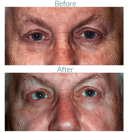 older male patient's eyes before and after eyelid reconstruction