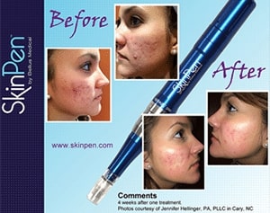 before and after Microneedling Skinpen Aurora CO
