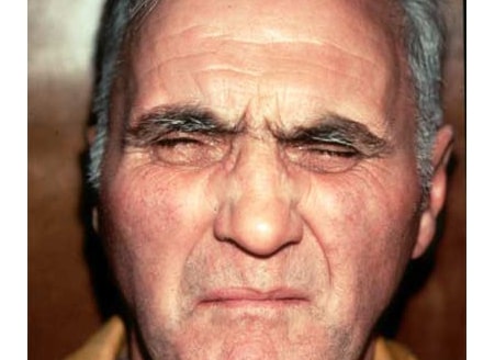 Blepharospasm Botox Treatment Denver CO