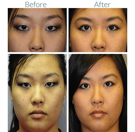 4 before and after photos of the same woman showing results of eyelid surgery