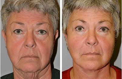 woman before and after facelift