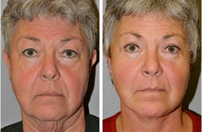 before and after Facelift Surgery Denver CO