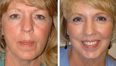 woman before and after facelift, face rejuvenated after procedure