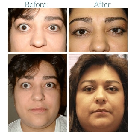 before and after Graves Disease Treatment Denver CO