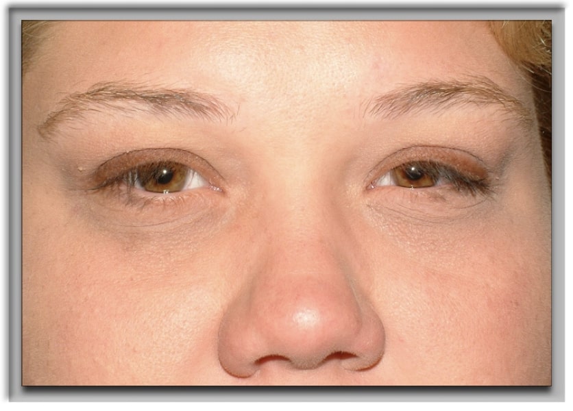 Floppy Eyelid Syndrome Surgery Denver CO