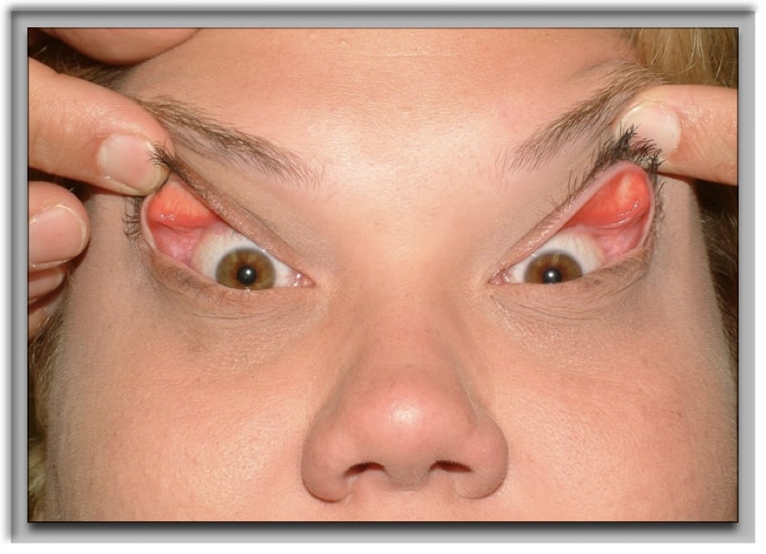 Floppy Eyelid Syndrome Surgery Aurora CO