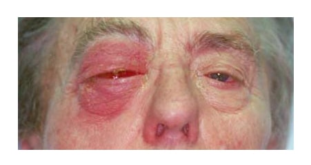 orbital cellulitis