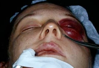 large red orbital tumor on female patient’s left eye