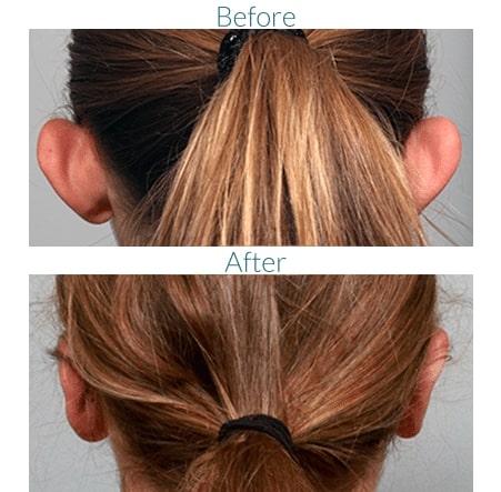 before and after otoplasty Denver CO