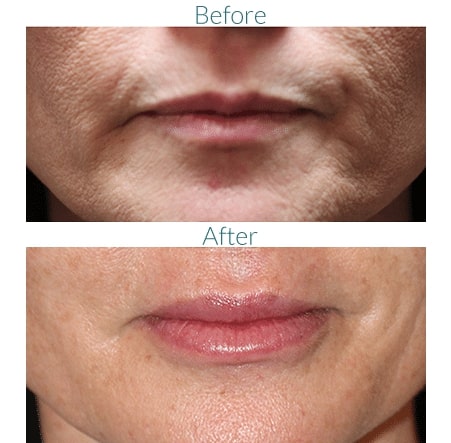 before and after facial filler Denver CO