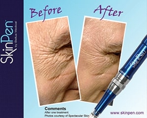 before and after Microneedling Denver CO