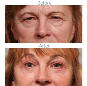 before and after of old woman's eyes after eyelid surgery