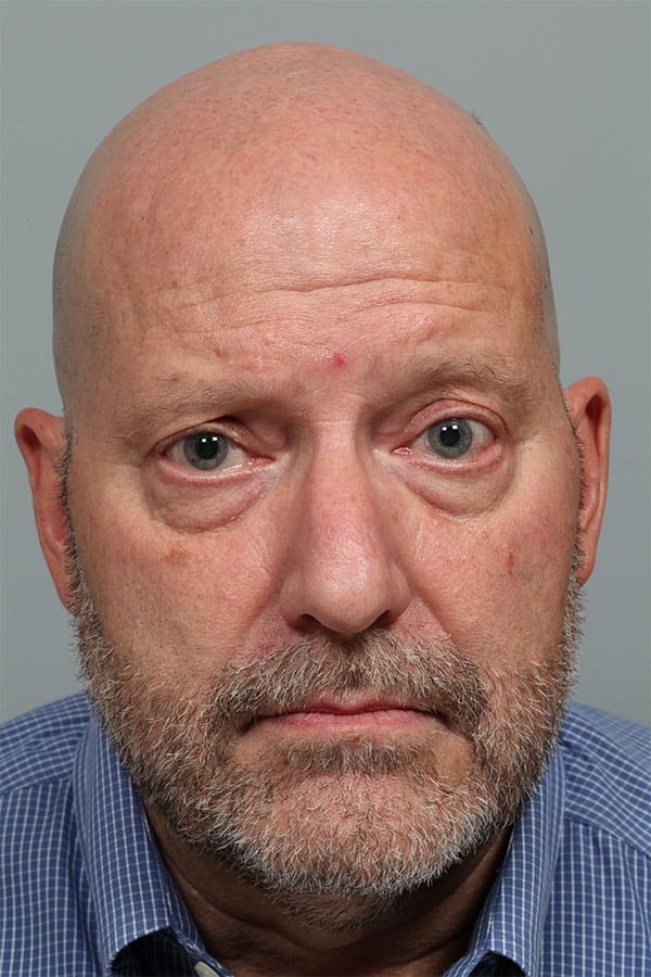 Before Image: Upper & Lower Blepharoplasty and Right Ptosis Repair - front