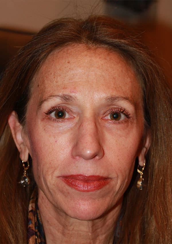After Image: Lower Blepharoplasty and Laser Resurfacing - front