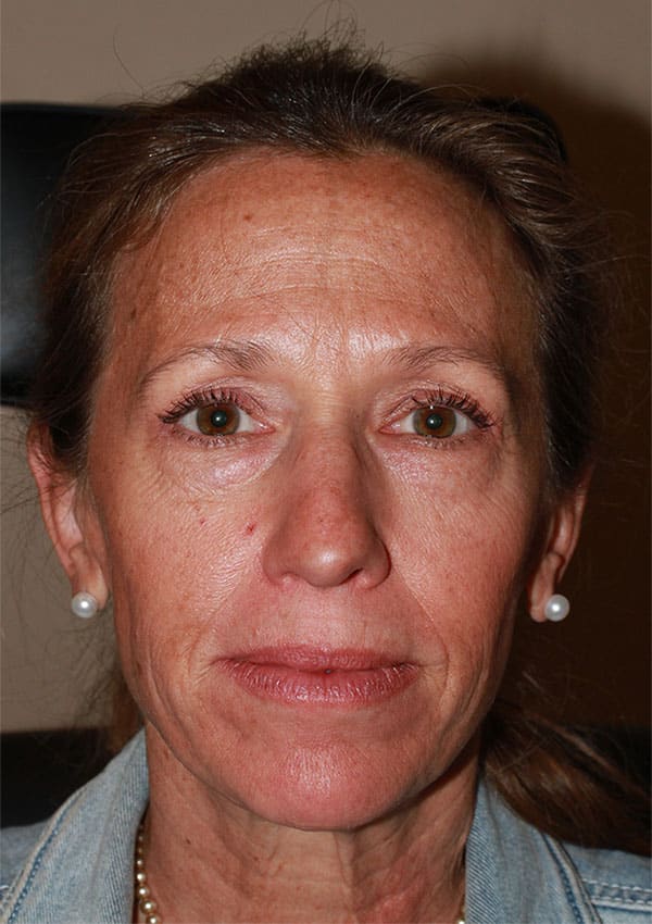Before Image: Lower Blepharoplasty and Laser Resurfacing - front