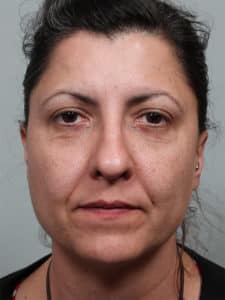 Lower Blepharoplasty with Xanthelasma Excision