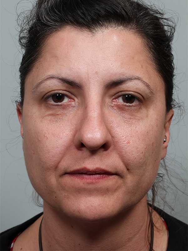 After Image: Lower Blepharoplasty with Xanthelasma Excision - front
