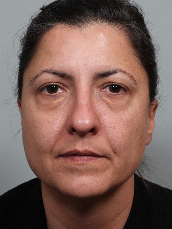 Lower Blepharoplasty with Xanthelasma Excision