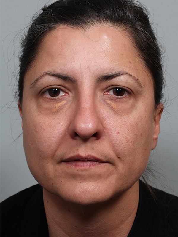 Before Image: Lower Blepharoplasty with Xanthelasma Excision - front