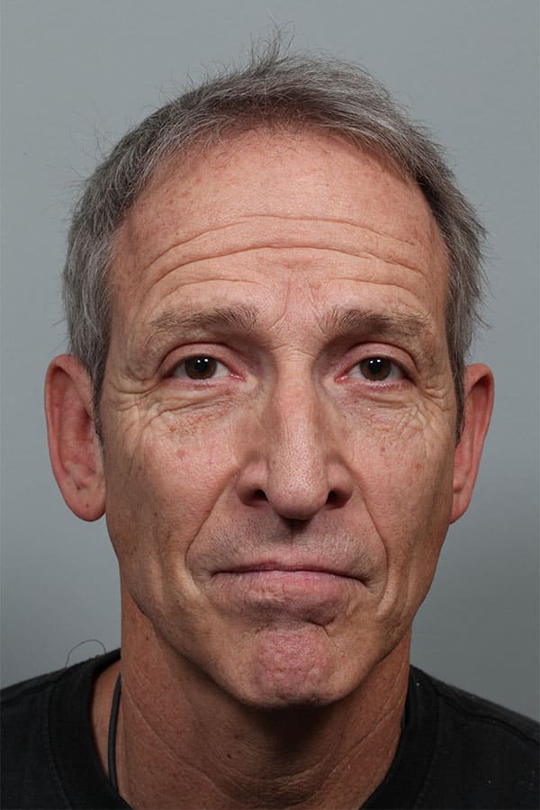 After Image: Upper Blepharoplasty - front