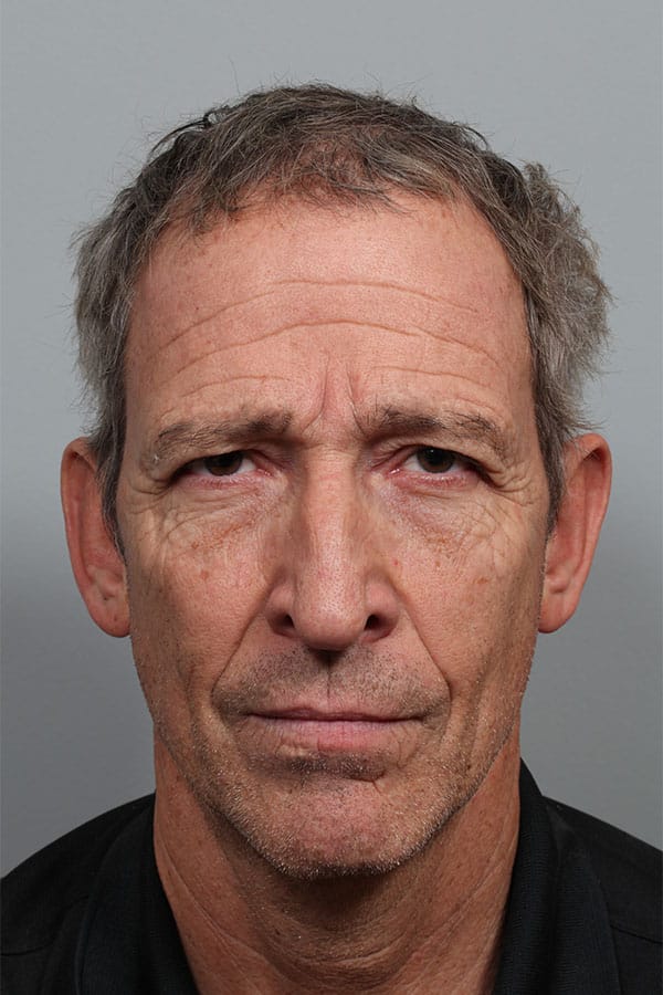 Before Image: Upper Blepharoplasty - front