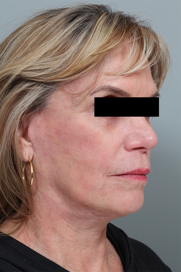 After Image: Facelift and Necklift - right-front-oblique