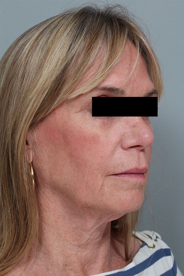 Before Image: Facelift and Necklift - right-front-oblique