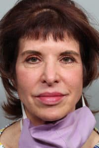Upper Blepharoplasty