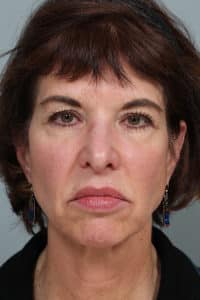 Upper Blepharoplasty