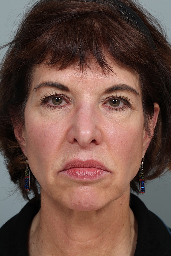 Before Image: Upper Blepharoplasty - front