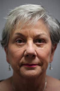 Upper & Lower Blepharoplasty and Ptosis Repair
