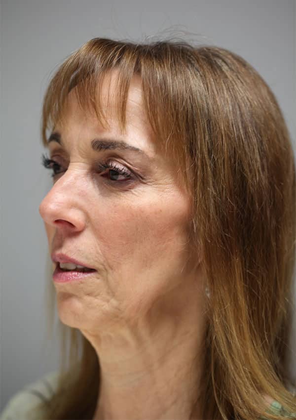 After Image: Mid-Facelift and Lower Blepharoplasty - left-front-oblique