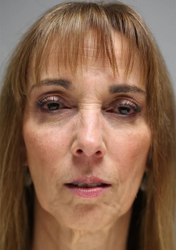 After Image: Mid-Facelift and Lower Blepharoplasty - front