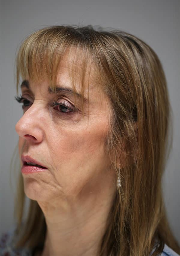 Before Image: Mid-Facelift and Lower Blepharoplasty - left-front-oblique
