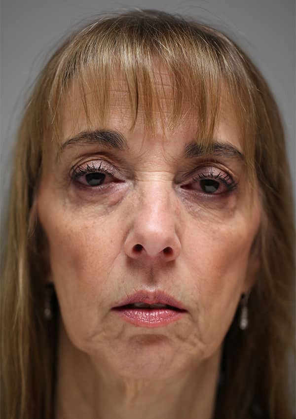 Before Image: Mid-Facelift and Lower Blepharoplasty - front