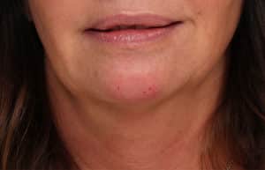 Juvéderm® Voluma (Chin)