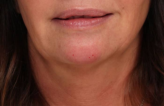 After Image: Juvéderm® Voluma (Chin) - front