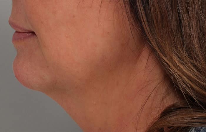 After Image: Juvéderm® Voluma (Chin) - left-side