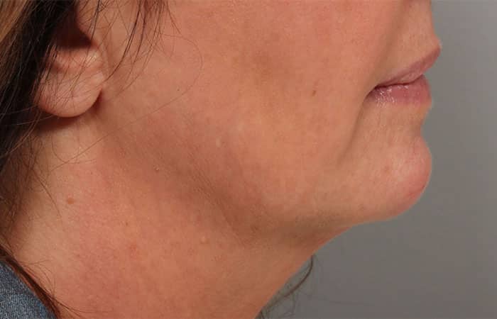 After Image: Juvéderm® Voluma (Chin) - right-side