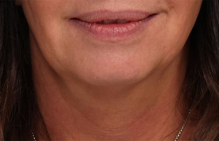 Before Image: Juvéderm® Voluma (Chin) - front