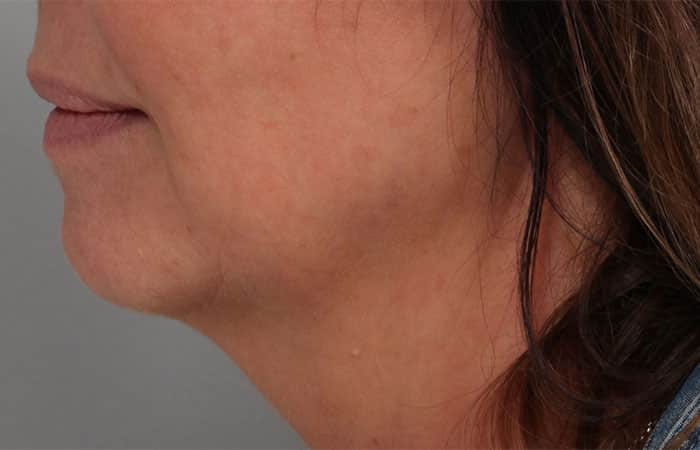Before Image: Juvéderm® Voluma (Chin) - left-side