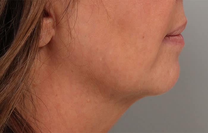 Before Image: Juvéderm® Voluma (Chin) - right-side