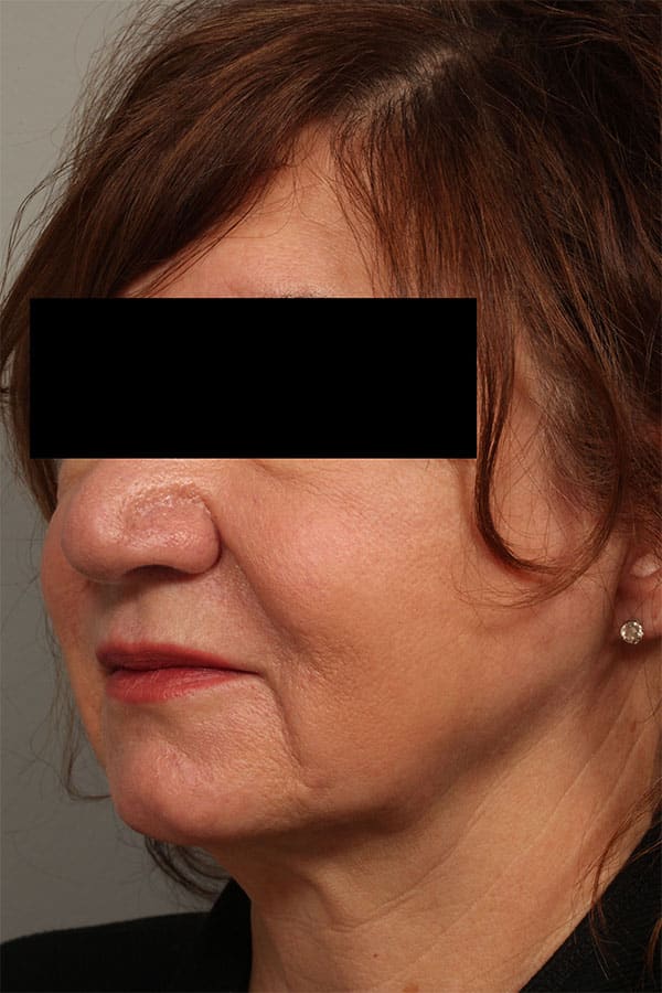 After Image: Allura Laser Assisted Lipo to Neck - left-front-oblique