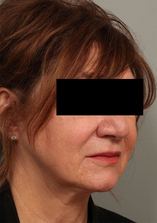 After Image: Allura Laser Assisted Lipo to Neck - right-front-oblique