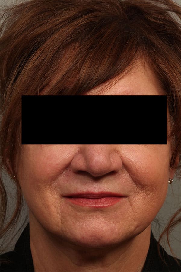 After Image: Allura Laser Assisted Lipo to Neck - front