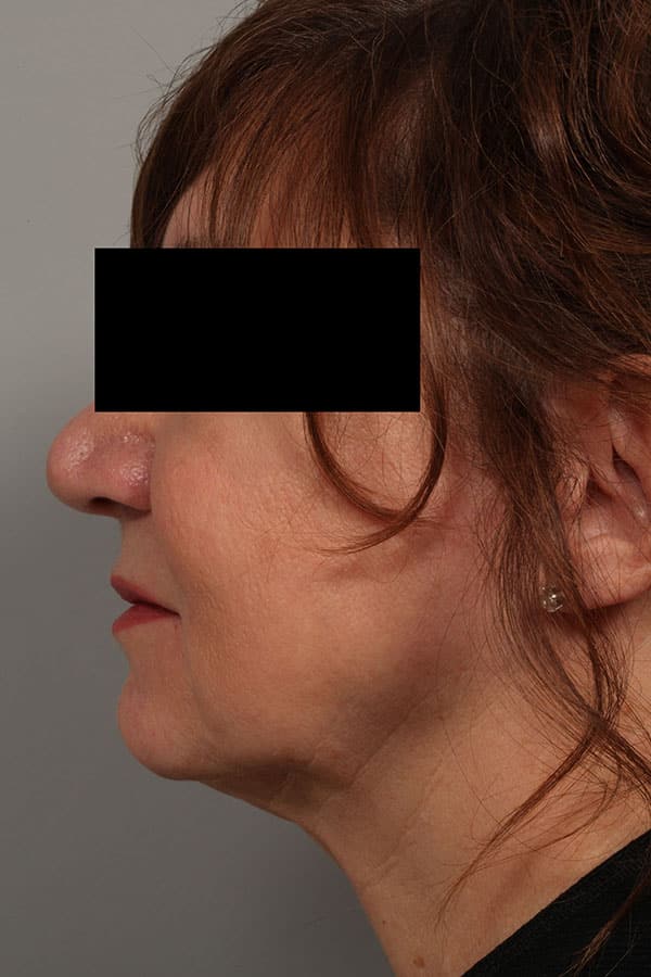After Image: Allura Laser Assisted Lipo to Neck - left-side