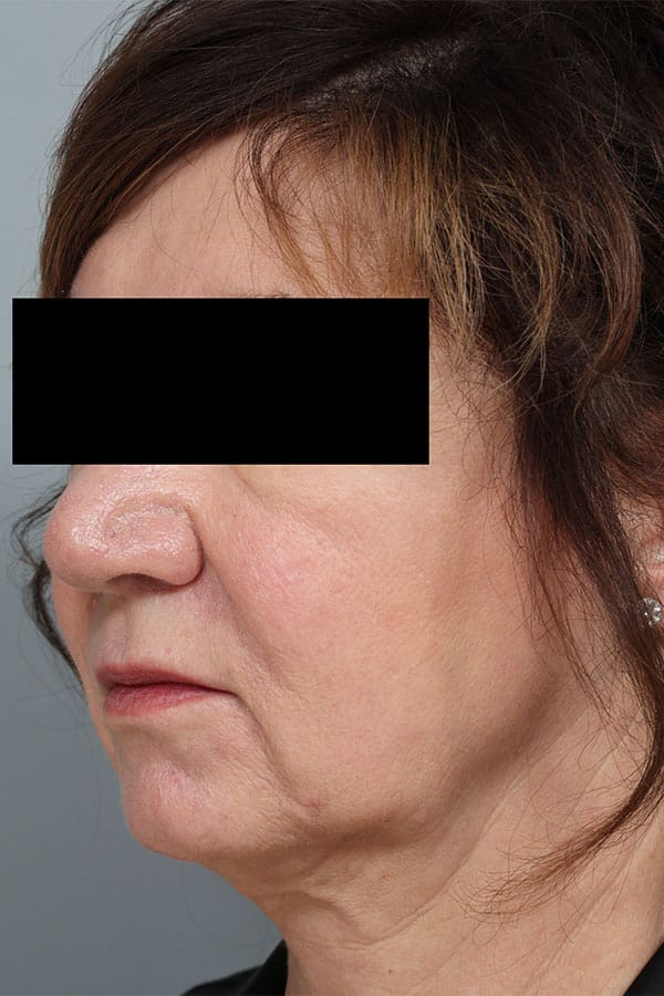 Before Image: Allura Laser Assisted Lipo to Neck - left-front-oblique
